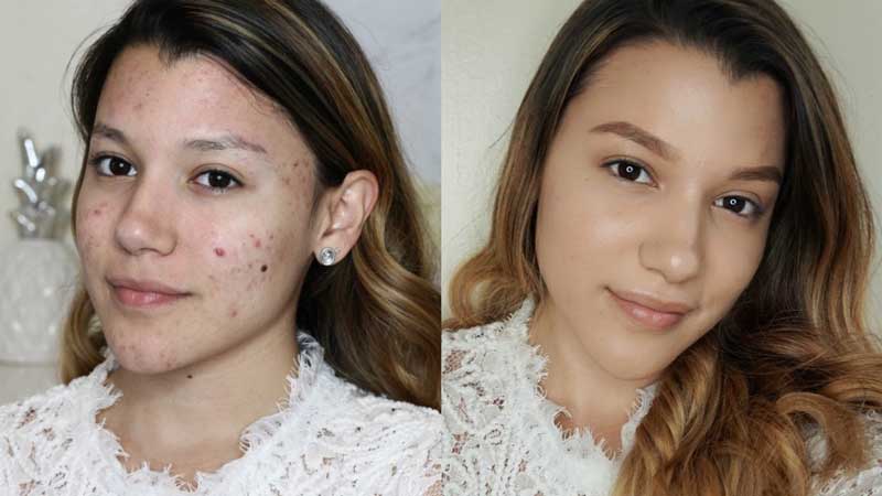 Comment avoir l'air d'avoir une belle peau quand on a de l'acné